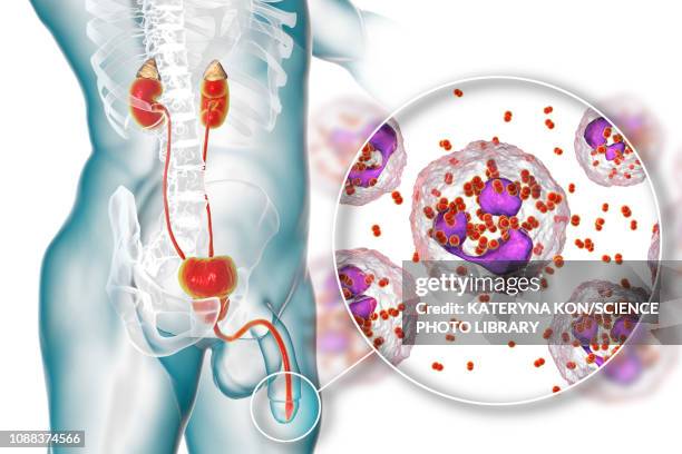 stockillustraties, clipart, cartoons en iconen met gonorrhoea infection in male, illustration - neisseria gonorrhoeae