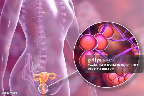 illustrations, cliparts, dessins animés et icônes de candida albicans infection in female, illustration - commensalisme