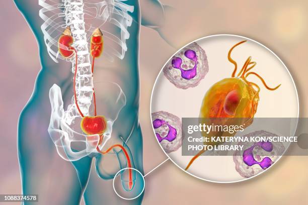 trichomoniasis, illustration - urethritis stock illustrations