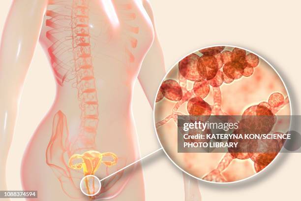 candida auris infection in female, illustration - candida albicans stock illustrations