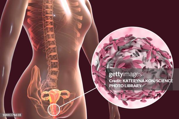 bacterial vaginosis, illustration - pap smear 幅插畫檔、美工圖案、卡通及圖標