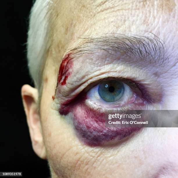 elderly woman with a black eye - contusion stock pictures, royalty-free photos & images