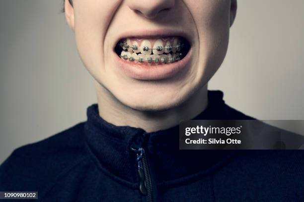 teenager showing teeth exposing braces - dental braces stock pictures, royalty-free photos & images