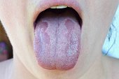 Oral Candidiasis or  Oral trush ( Candida albicans), yeast infection on the human tongue close up, common side effect when using antibiotics or another medicaments