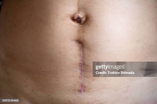 mother showing caesarian scar - female navel ストックフォトと画像