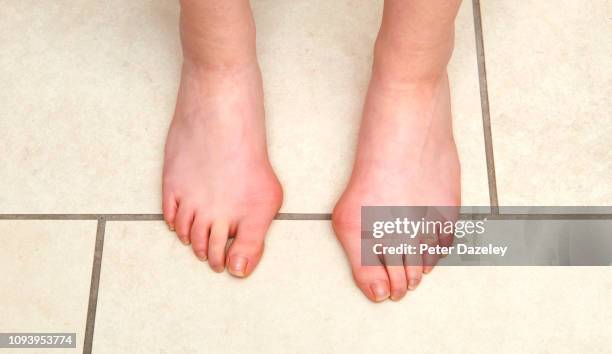 teenager with bunions - hallux valgus foto e immagini stock