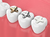 3d render of teeth with inlay