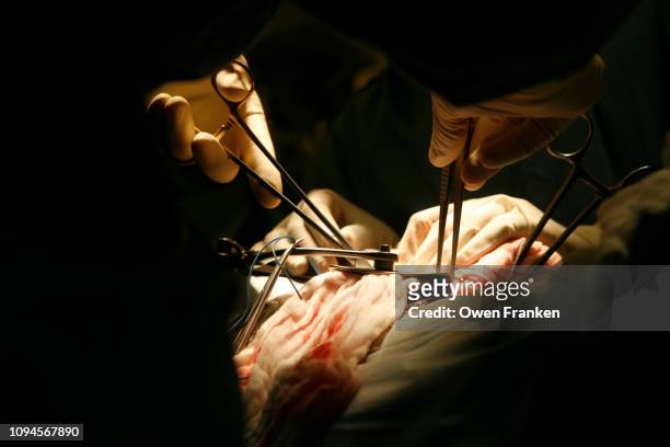 kidney transplant operation in paris public assistance hospital st. louis - transplant surgery stock pictures, royalty-free photos & images