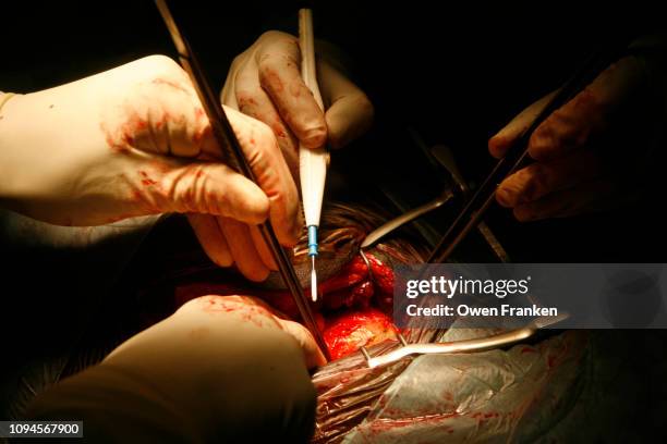 kidney transplant operation in paris public assistance hospital st. louis - transplant surgery stock pictures, royalty-free photos & images