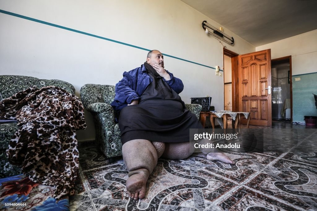 Palestinian man with lymphedema