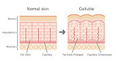 Comparative illustration of normal skin and cellulite's skin