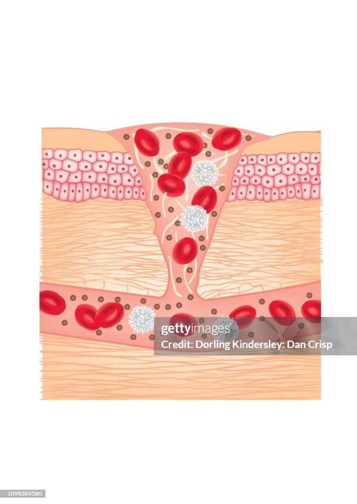Cut-through illustration showing blood clotting. Skin healing process
