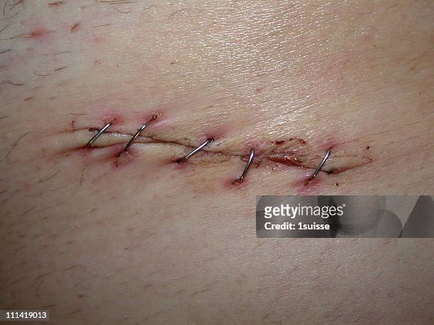 scar of appendicitis - medical stitches ストックフォトと画像