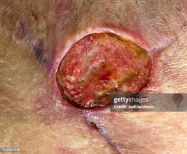 methicillen resistant staphylococcus aureus - skin tissue stock pictures, royalty-free photos & images