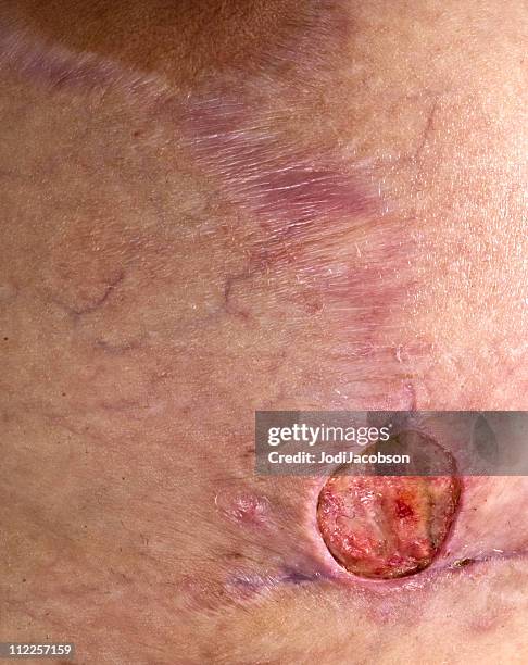 methicillin resiststant staphylococcus aureus breast - wounded stockfoto's en -beelden