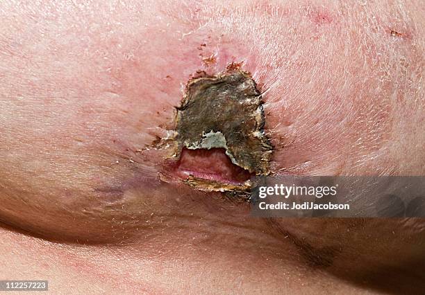 methicillen resistant staphylococcus aureus treated with silver nitrate - antibiotic resistance stock pictures, royalty-free photos & images