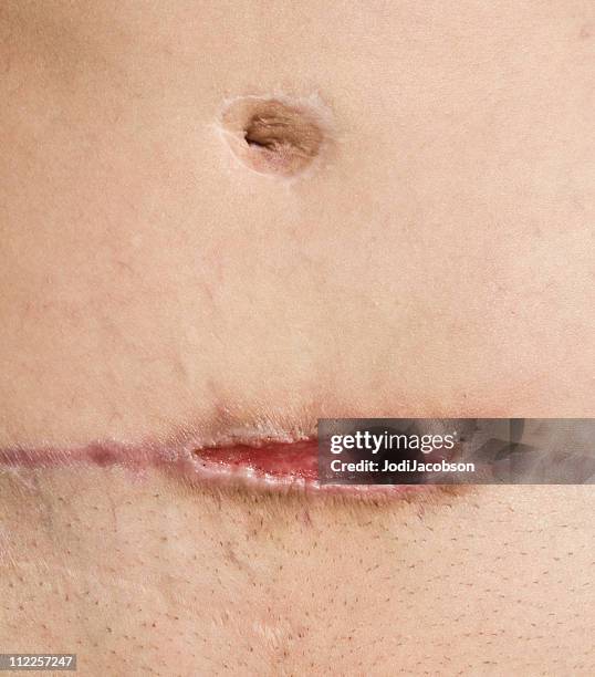methicillen resistant staphylococcus aureus abdomen - stomach stitches stock pictures, royalty-free photos & images