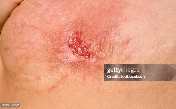 methicillen resistant staphylococcus aureus - mrsa stock pictures, royalty-free photos & images