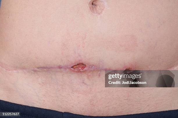 methicillen resistant staphylococcus aureus abdomen 2 - stafylokokken stockfoto's en -beelden