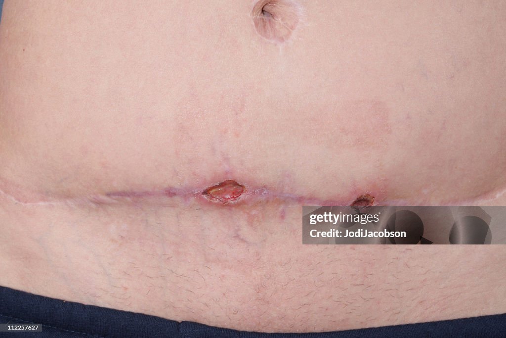 Methicillen Resistant Staphylococcus Aureus Abdomen 2