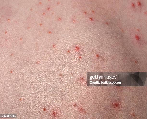 folliculitis on child's back (barbers itch) - acne back stock pictures, royalty-free photos & images