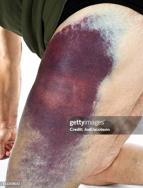 hematoma from a motorcycle accident - blood clot stock pictures, royalty-free photos & images