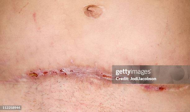 mrsa un año después - suture fotografías e imágenes de stock