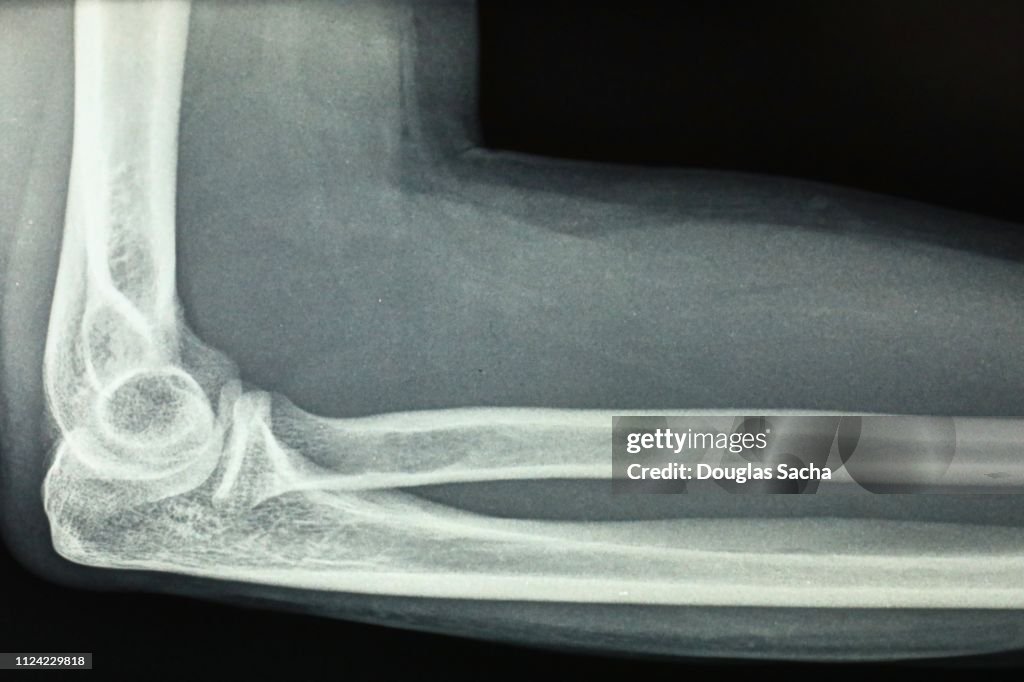 X-ray image of a human elbow and forearm