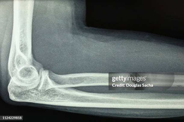 x-ray image of a human elbow and forearm - hinge joint stock pictures, royalty-free photos & images