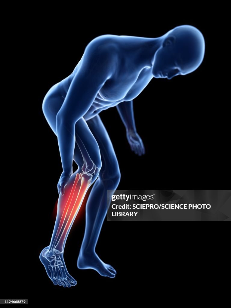 Illustration of a man with a painful calf