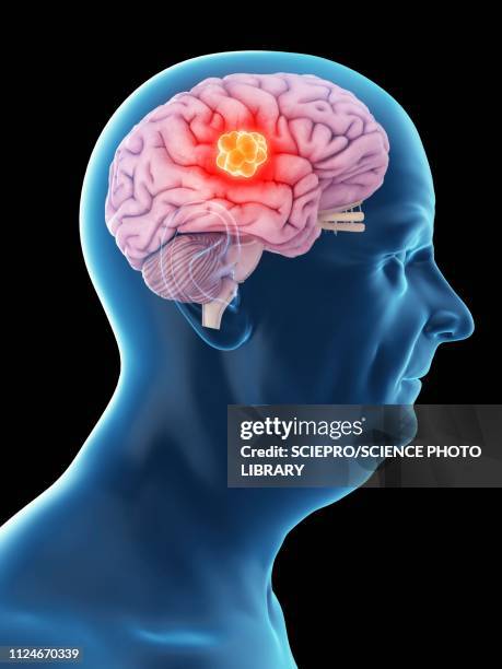 illustration of an old man's brain cancer - brain tumour stock illustrations