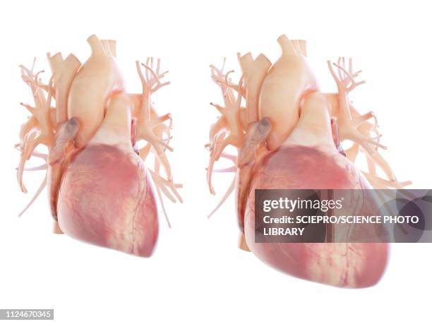 Heart Inlarge Image Illustration Of An Enlarged Heart High-Res Vector Graphic - Getty Images