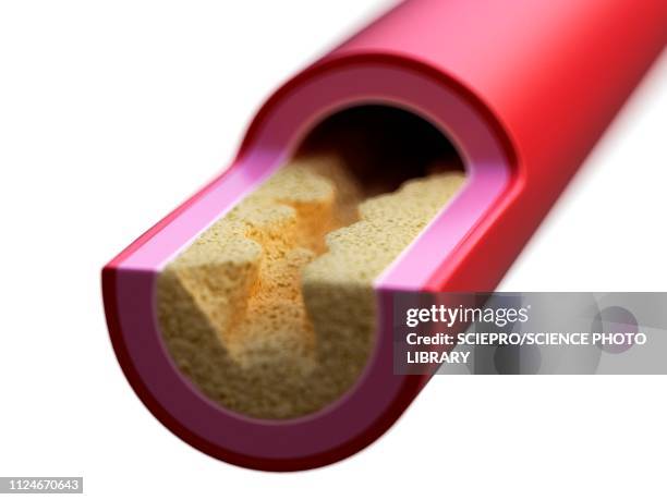 illustration of a blocked artery - atherosklerose stock-grafiken, -clipart, -cartoons und -symbole