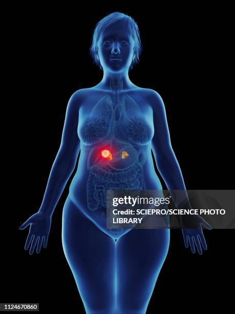 illustration of a tumour in a woman's adrenal gland - cushing oklahoma stock illustrations