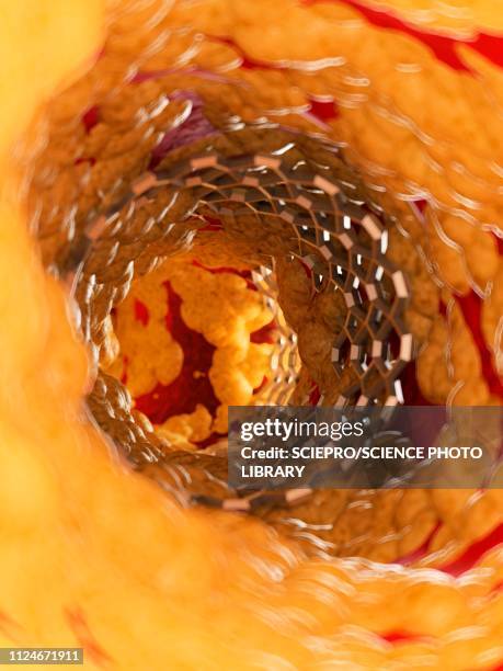 ilustraciones, imágenes clip art, dibujos animados e iconos de stock de illustration of a stent inside of an artery - arteria