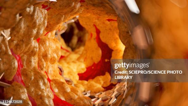 illustration of a stent inside of a fatty artery - stent stock illustrations