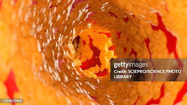 illustration of fat inside of an artery - atherosklerose stock-grafiken, -clipart, -cartoons und -symbole