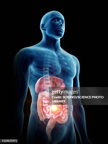 ilustrações, clipart, desenhos animados e ícones de illustration of a painful digestiverticale system - inflamação