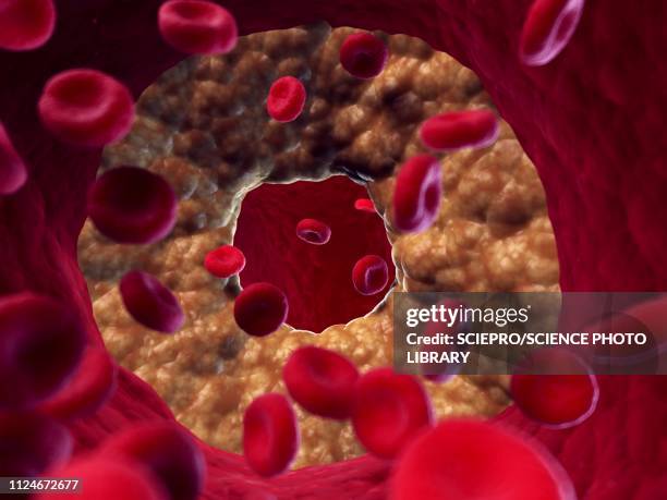 illustration of a blocked artery - artery stock illustrations