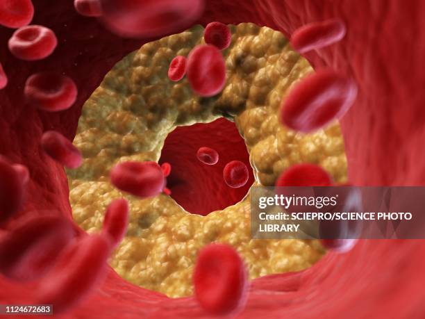 ilustrações de stock, clip art, desenhos animados e ícones de illustration of a blocked artery - colesterol