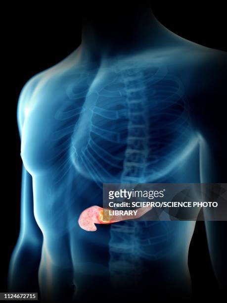 illustration of a man's pancreas tumour - bauchspeicheldrüsenkrebs stock-grafiken, -clipart, -cartoons und -symbole
