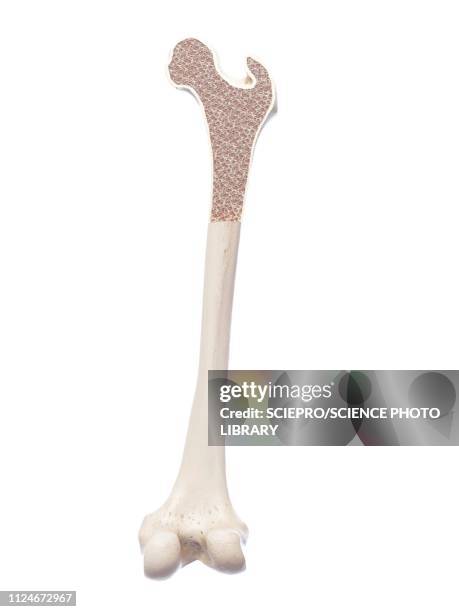 stockillustraties, clipart, cartoons en iconen met illustration of osteoporosis - osteoporose