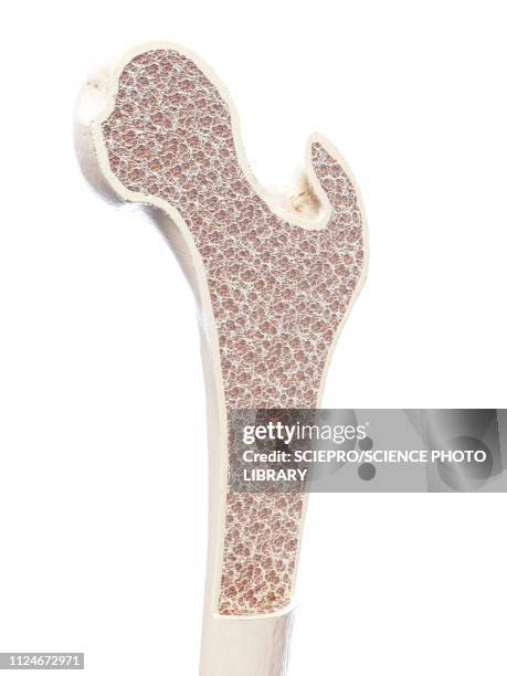 ilustraciones, imágenes clip art, dibujos animados e iconos de stock de illustration of osteoporosis - bones