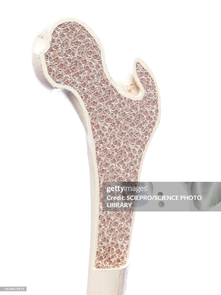 Illustration of osteoporosis