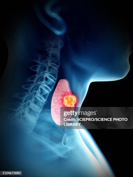 illustration of a man's thyroid tumour - hypothyroidism stock illustrations