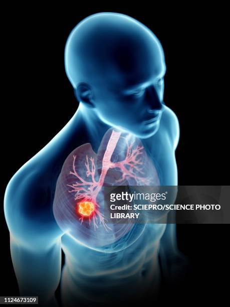 illustration of a man's lung tumour - bronchien stock-grafiken, -clipart, -cartoons und -symbole