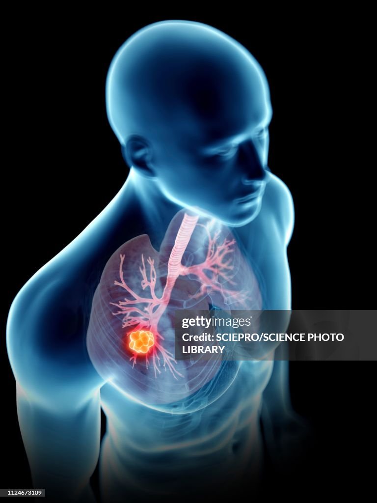 Illustration of a man's lung tumour