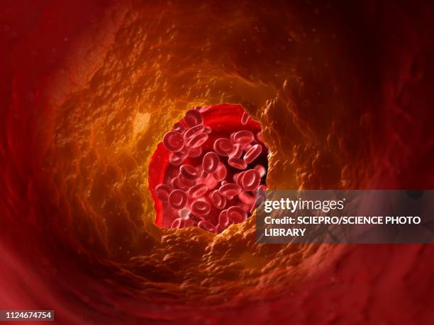 stockillustraties, clipart, cartoons en iconen met illustration of a blocked artery - cholesterol