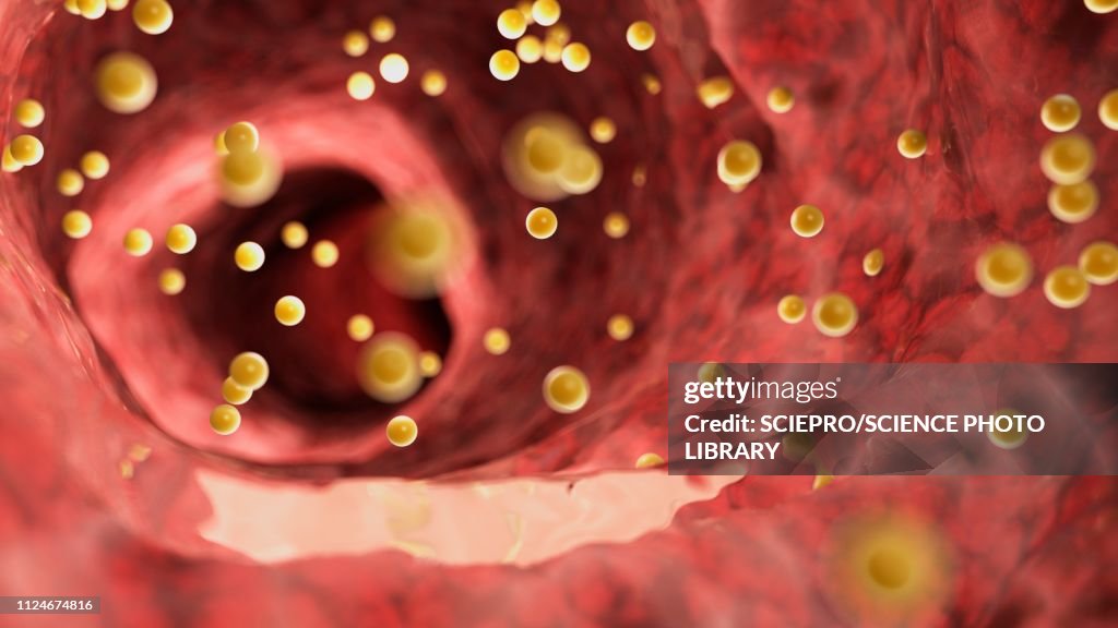 Illustration of colon inflammation caused by gluten