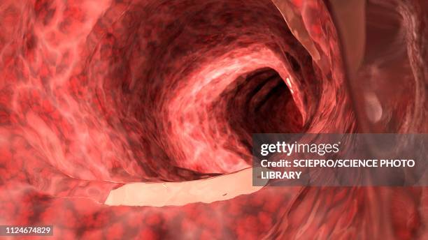 illustration of an inflamed colon - 腸細胞点のイラスト素材／クリップアート素材／マンガ素材／アイコン素材